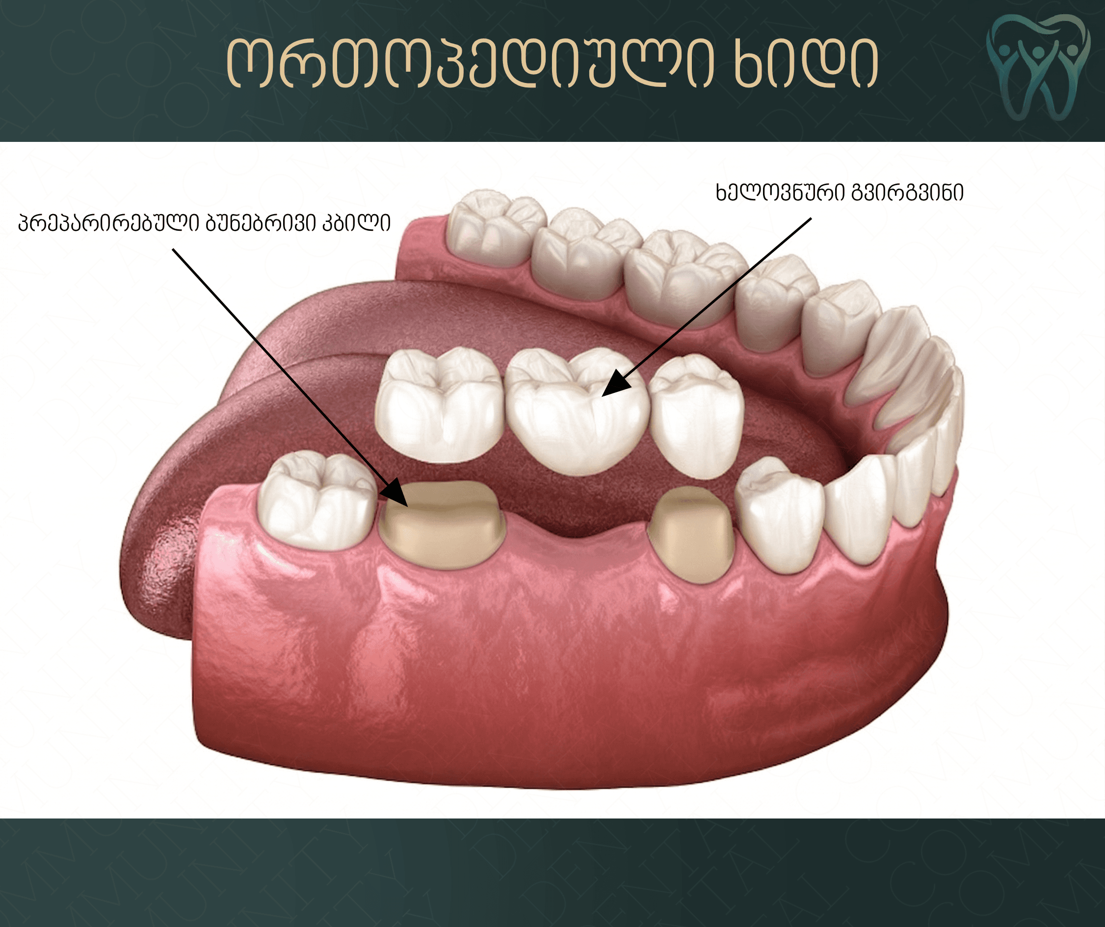 Dental Bridge